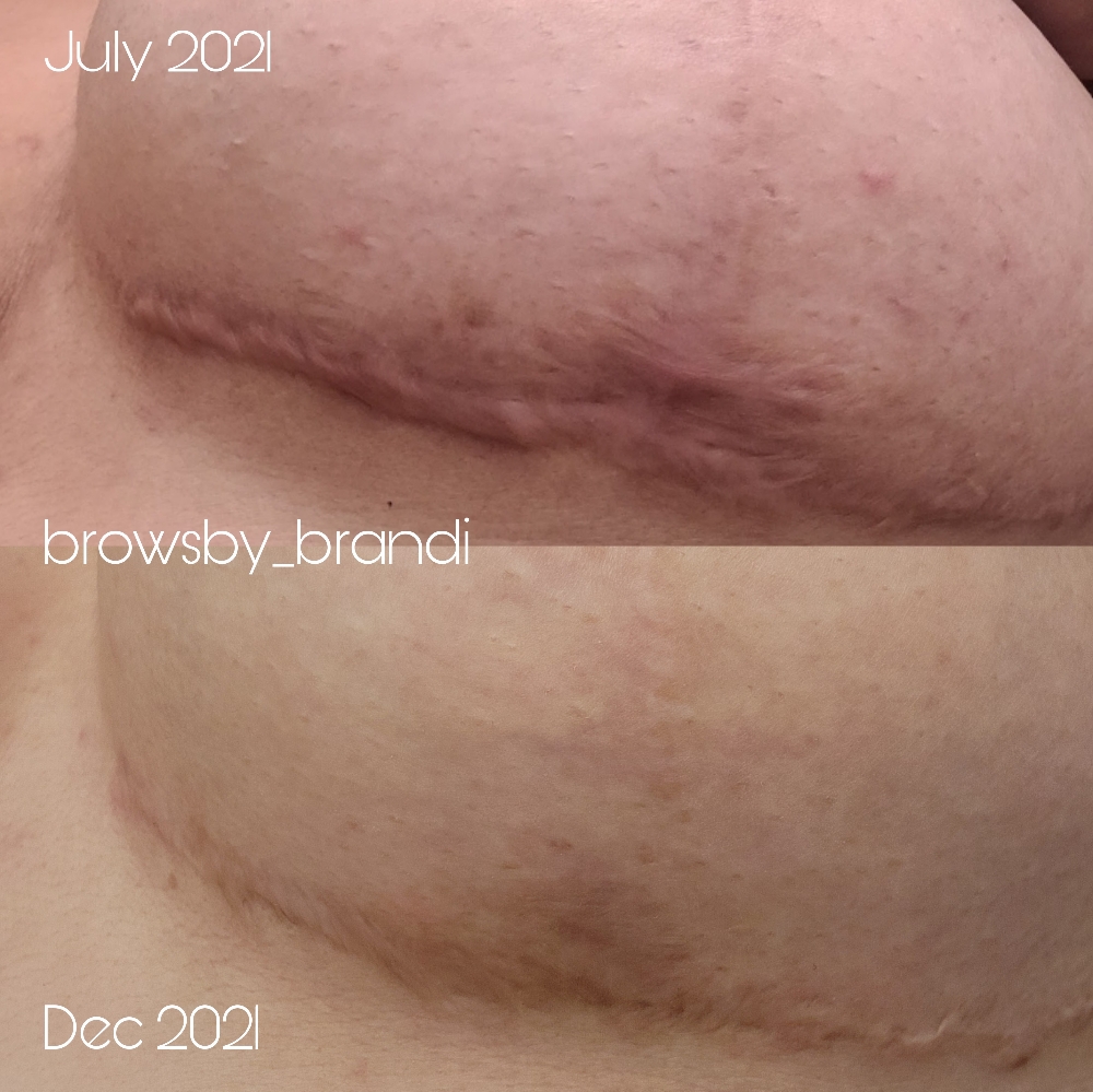 Plasma Pen Stretch Mark/Scar Repair