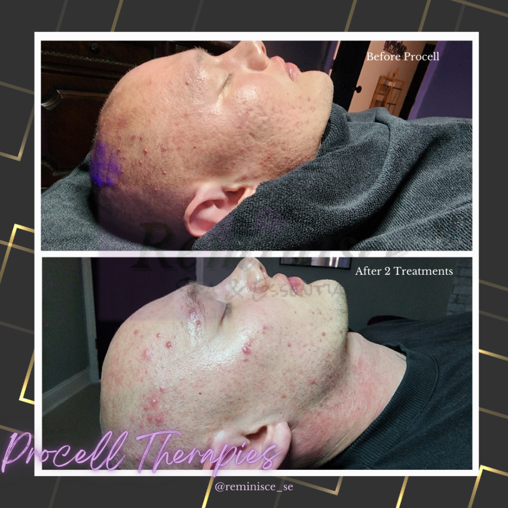 Procell Therapy (Microchanneling)