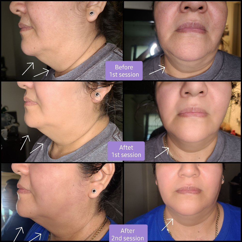 RF Facial Tightening&Lift 3sessi