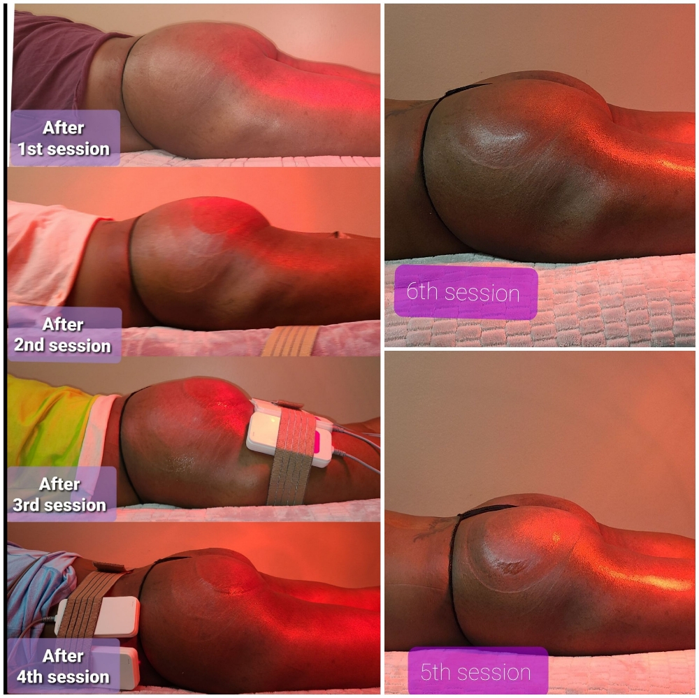 BBL Vacua Therapy 6Session 1hour