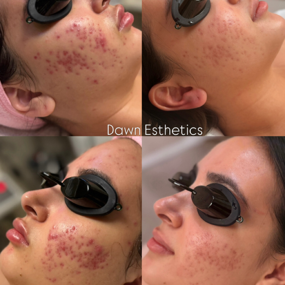Acne Clearing Facial at Dawn Esthetics in Colorado Springs, CO
