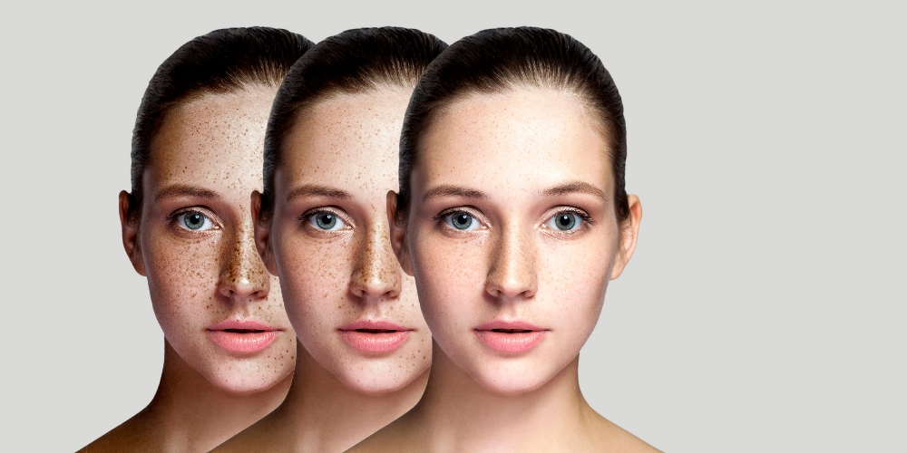 Pigmentation Removal w/ Picosure