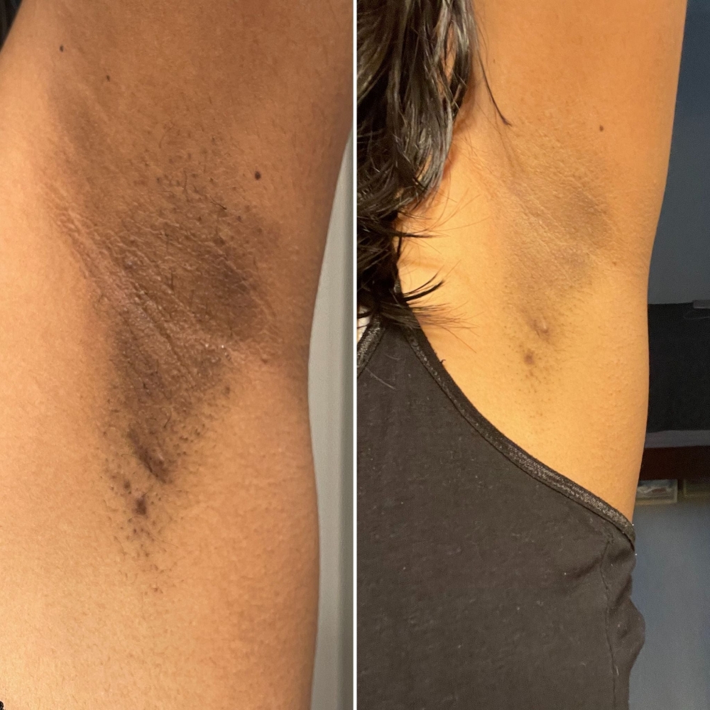 Skin Brightening Treament Series