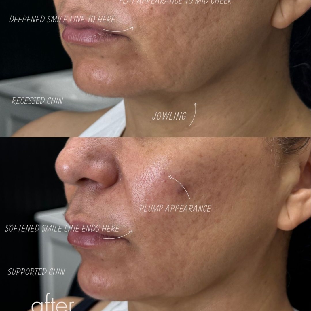 Facial Balancing | The Mini Dose at DOSE OF BEAUTY in Mission, TX