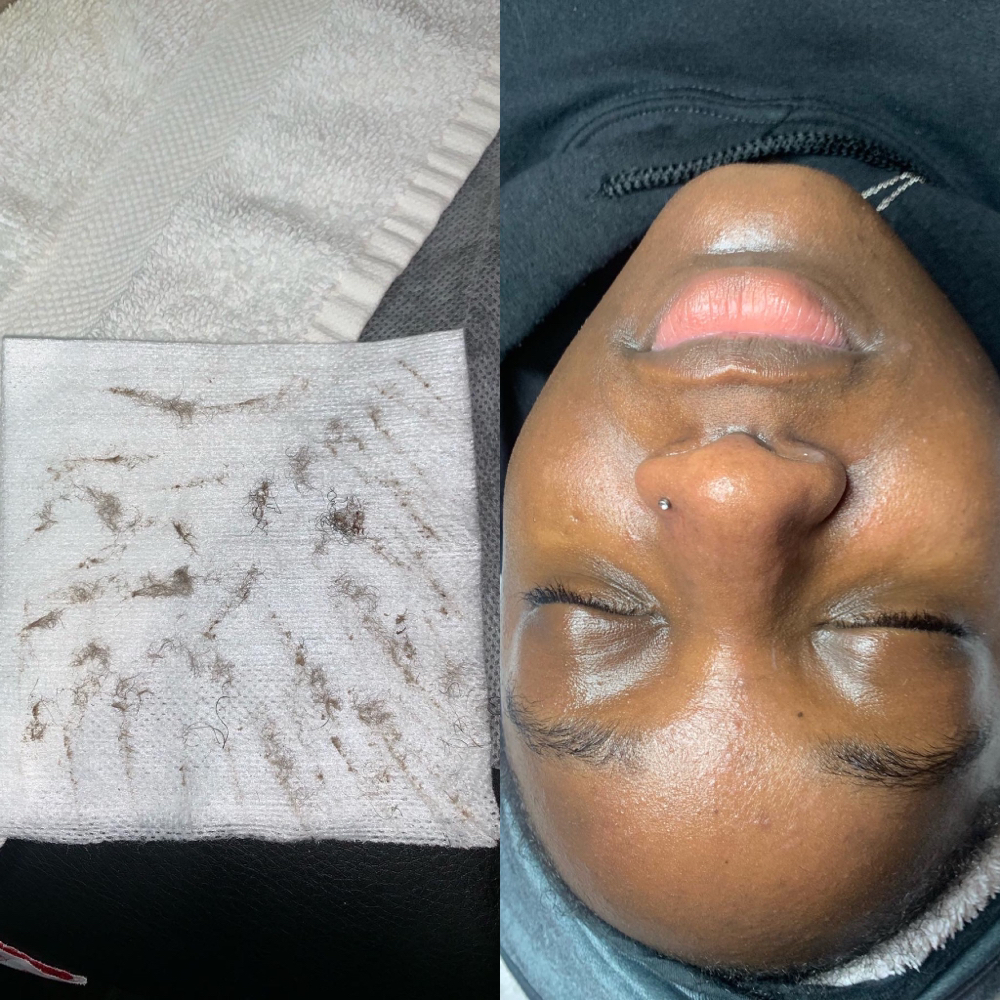 Dermaplane Facial