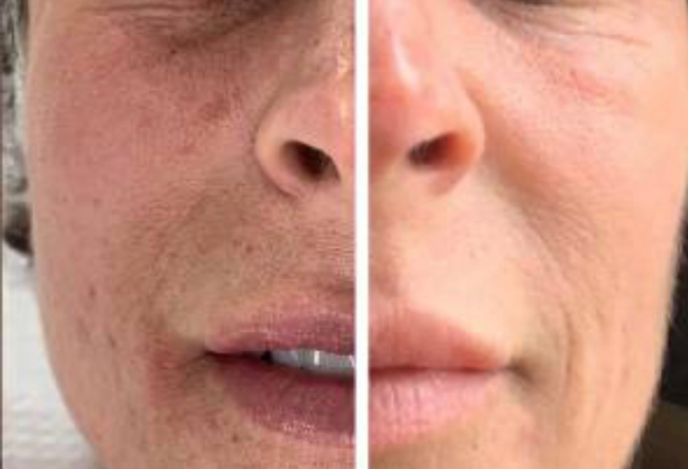 GET GLOWING MICRO PEEL