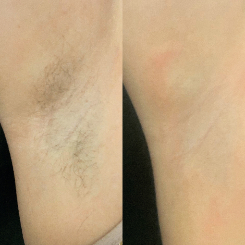 Underarm Wax