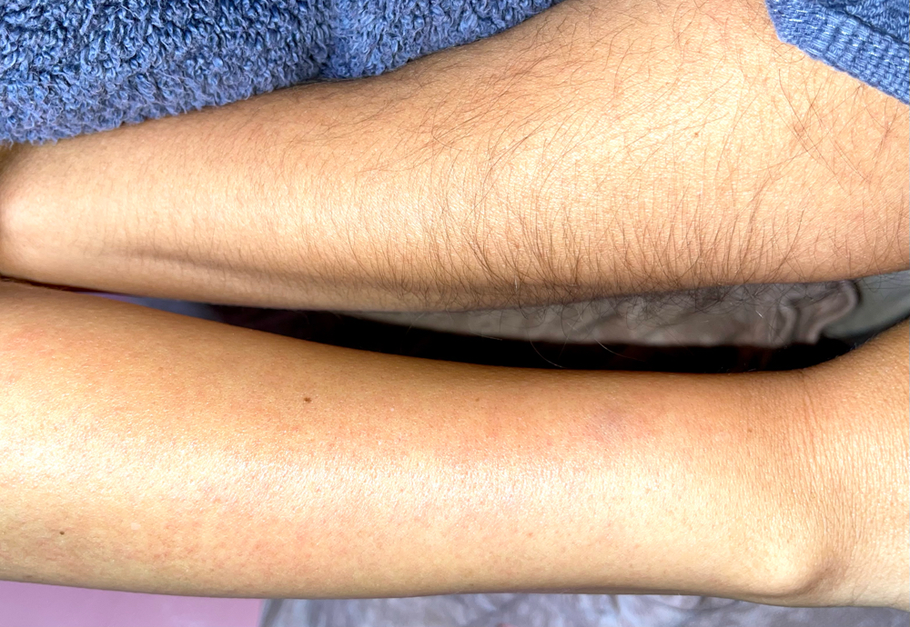 Half Arms
