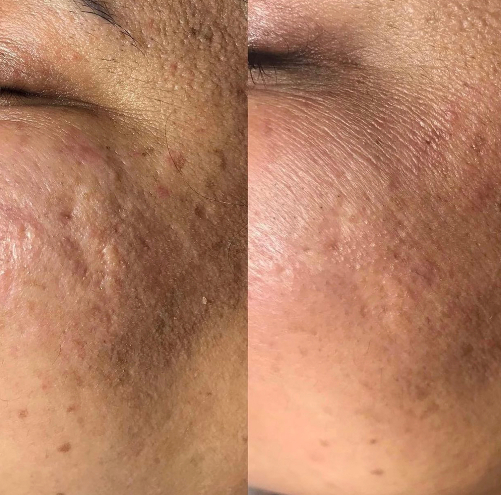 RF MICRONEEDLING