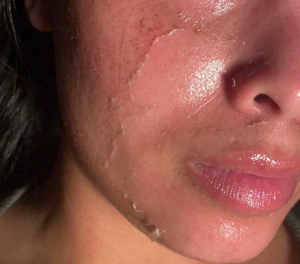 CHEMICAL PEEL (Level 1)