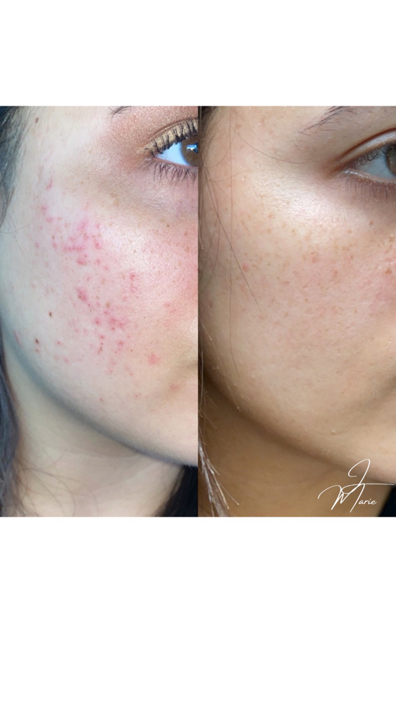 ACNE BOOT CAMP CONSULT