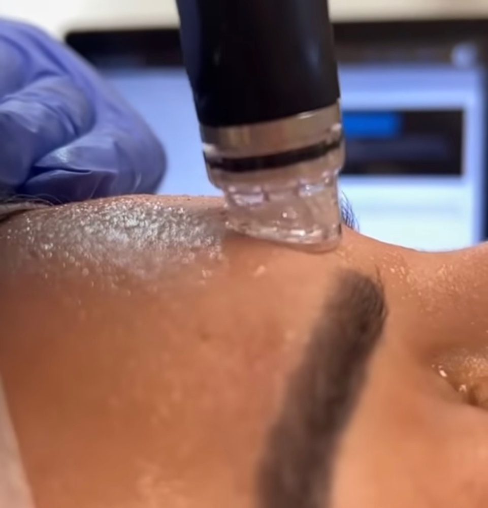 HYDRAFACIAL SIGNATURE