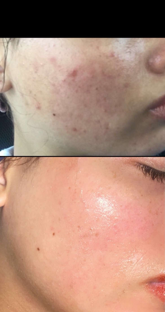 ACNE Customized Complete Facial