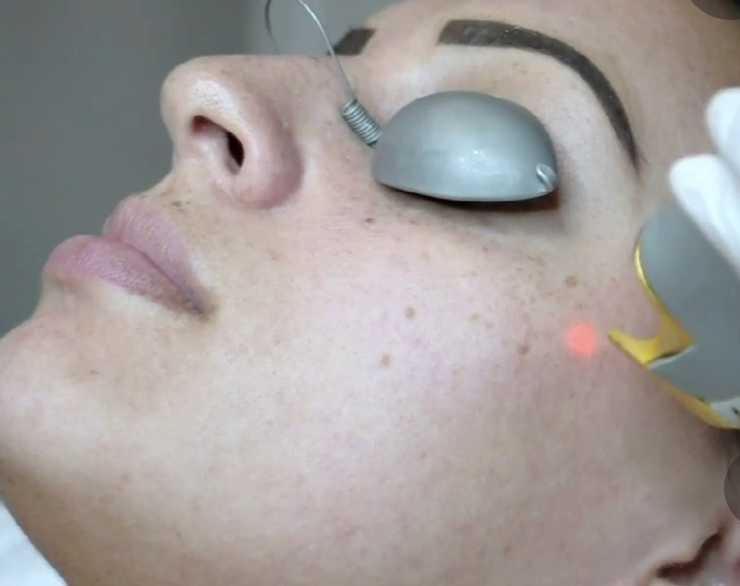 LASER GENSISS (Acne/Texture)