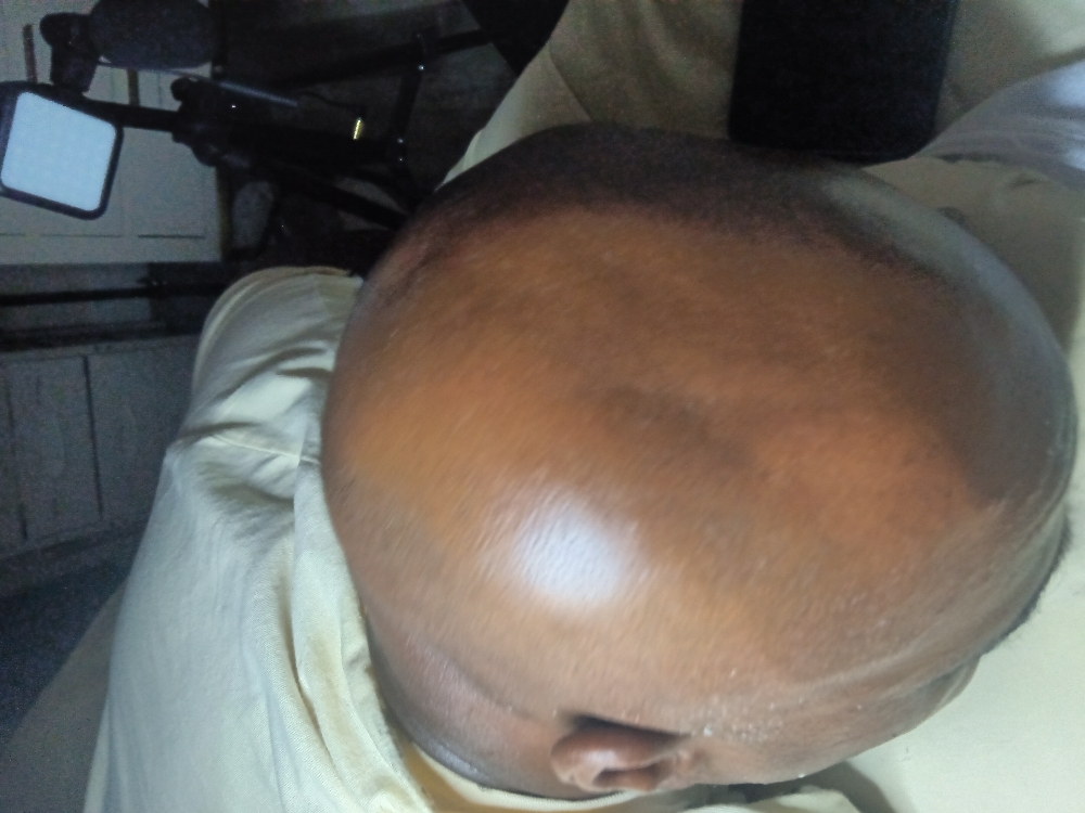 Microdermabration Scalp Treatment at Alliah's Beauty & Wellness  Salon, Inc in San Bernardino, CA