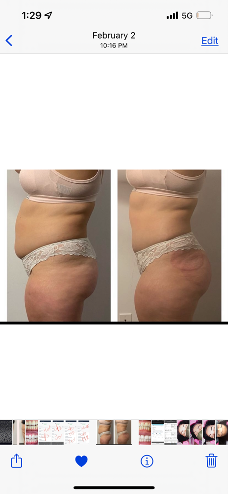 Laser Lipo + Lipo Cavitation