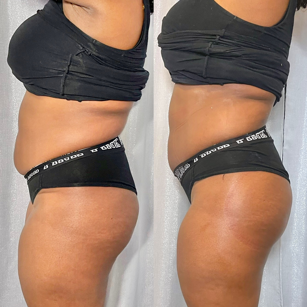 Ultrasonic Cavitation
