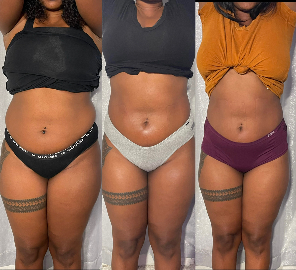 Ultrasonic Cavi + Laser Lipo