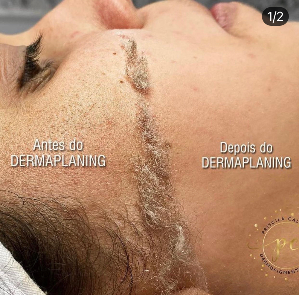 Dermaplaning Facial