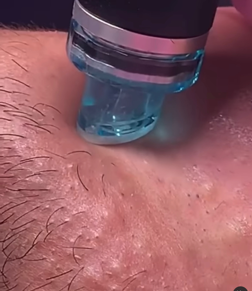 Signature Hydrafacial