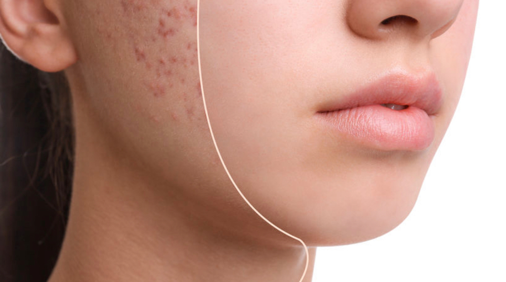 Acne Facial