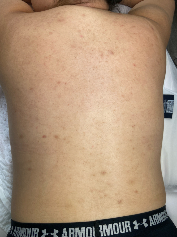 Backfacial For Hyperpigmentation