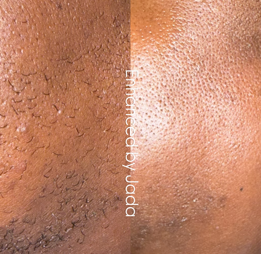 Ingrown Hair Removal