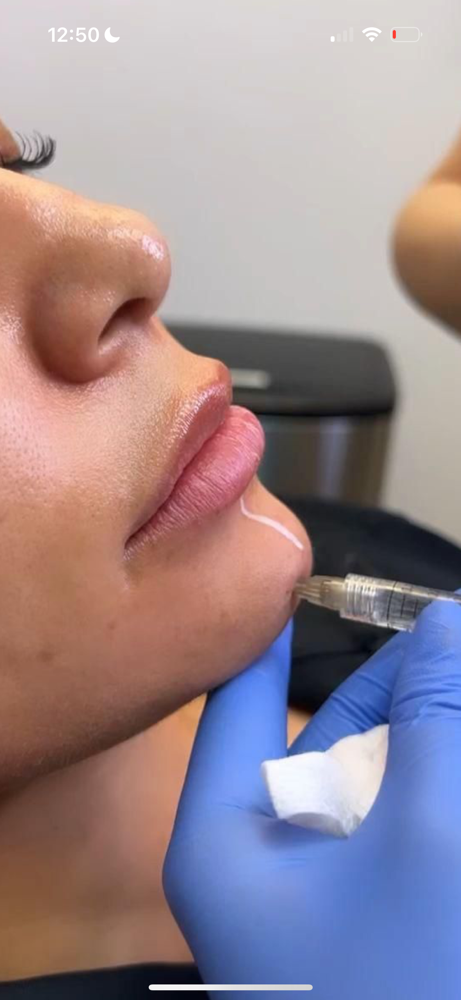 chin filler 1 Syringe