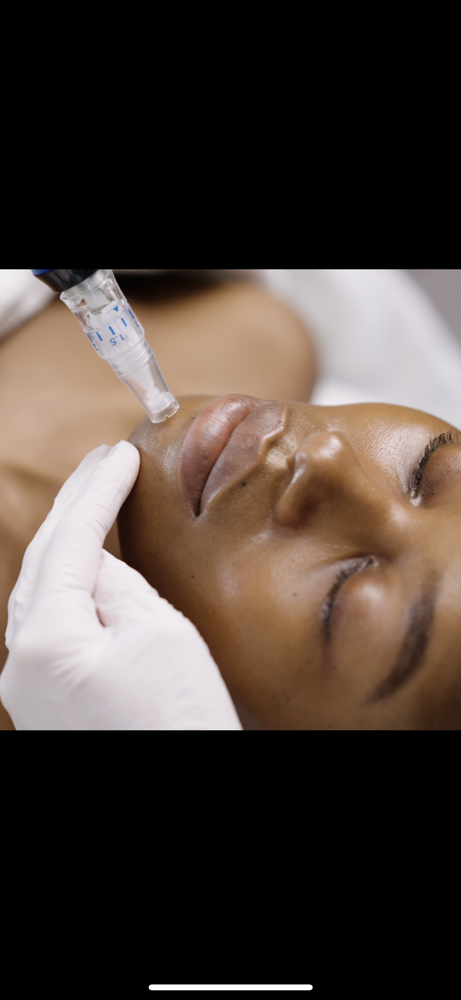 Microneedling Facial