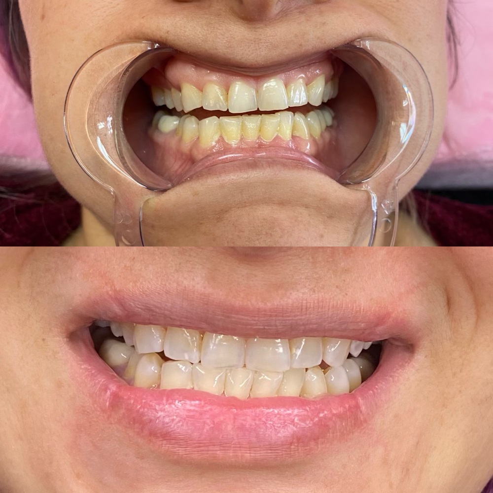 Teeth Whitening Add On With Service