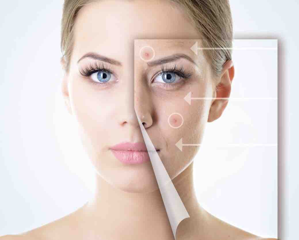 Teen And Adult acne Facial