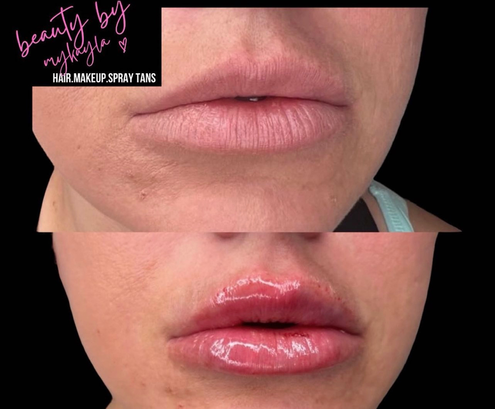 needle-less filler refresher 👄