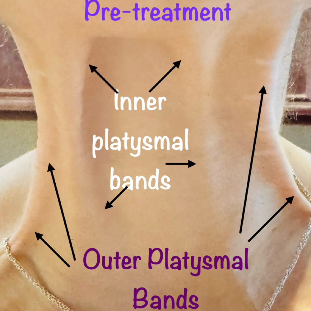 Platysmal Bands at Hypnotic Aesthetic in Lavon, TX