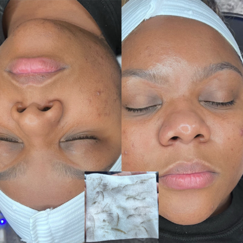 Dermaplane Facial at K8ER in Akron, OH