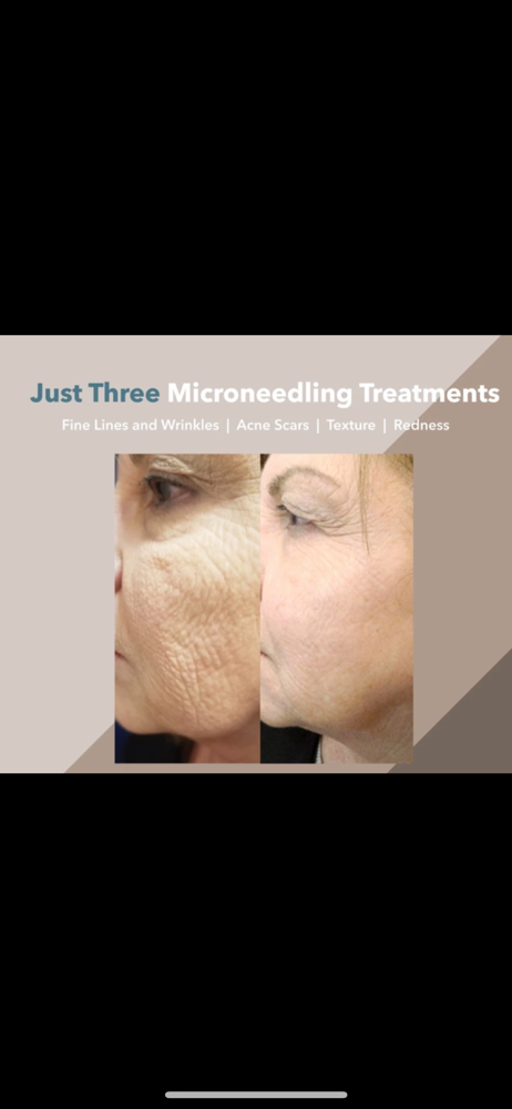 Microneedling Facial 1 Session