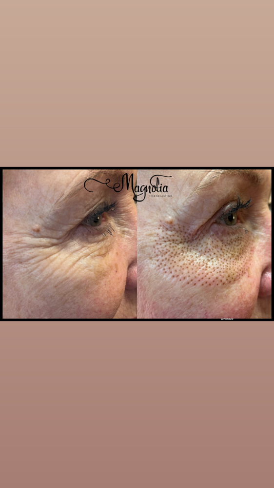 Lower Eyelids and Crows Feet Combo