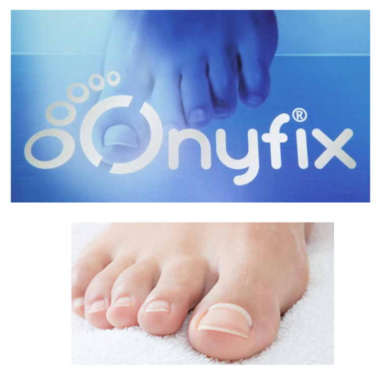 Onyfix Big Toe Nail