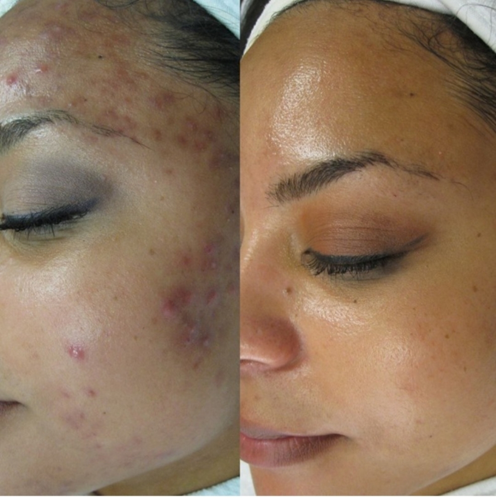 Advance Acne Treatment