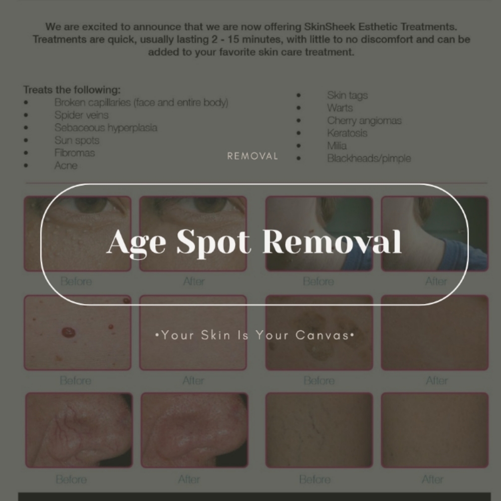 Age Spot Removal at Face Palette Aesthetics in Franklin, WI