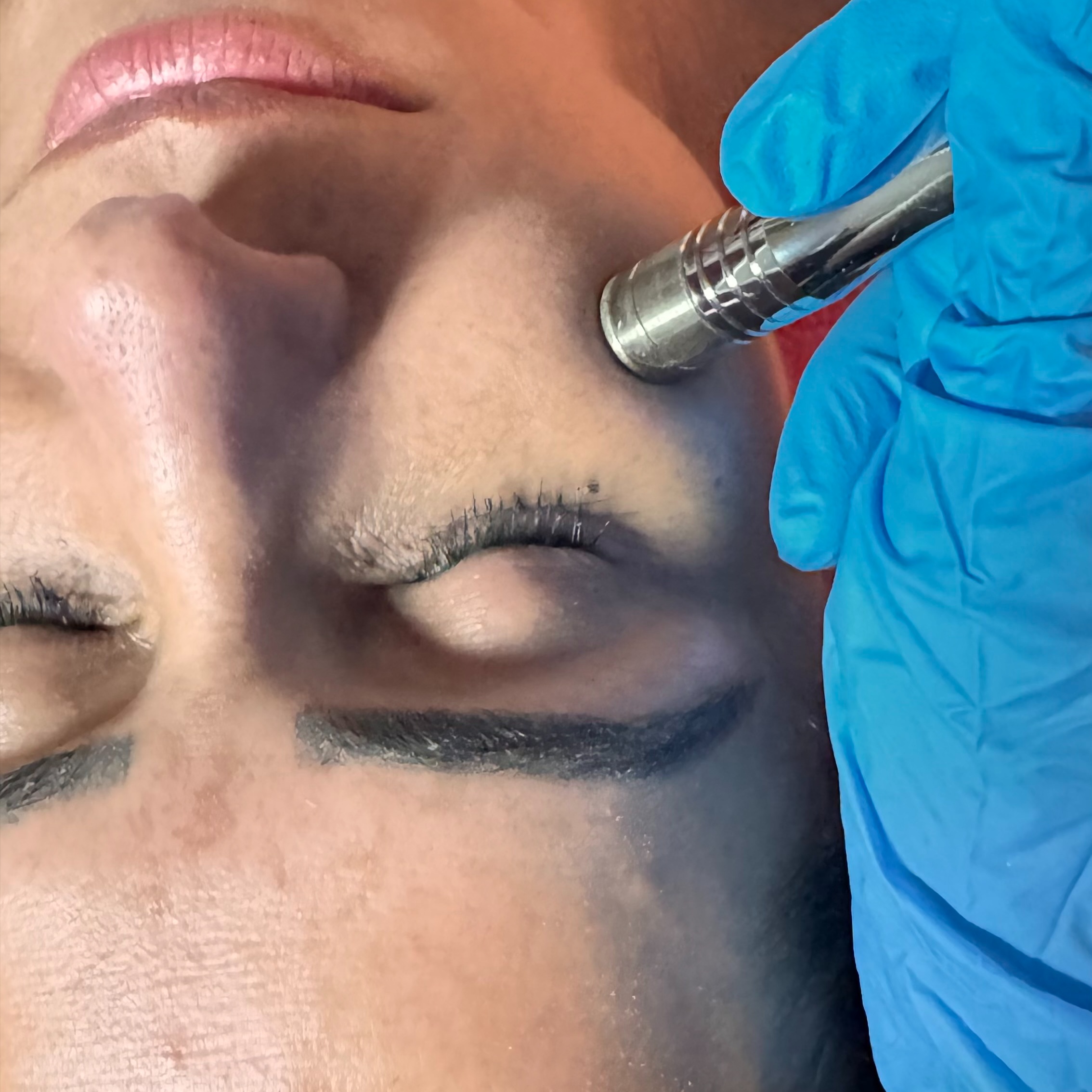 Microdermabrasion at Eula Skin in Dallas, TX