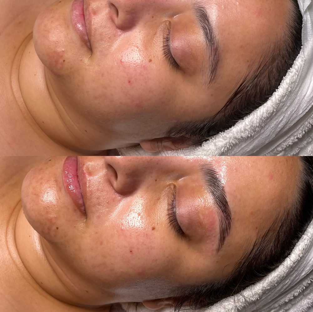 Deep Clarity Acne Facial