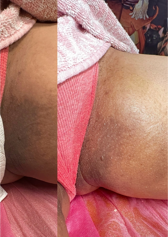 Inner Thighs Skin Lightening