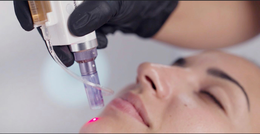 Micro-Needling