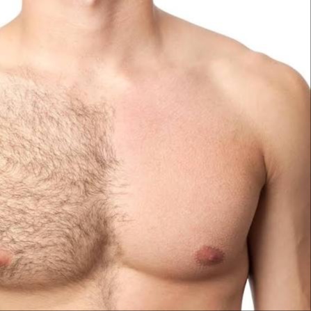 Chest and Abdomen at Illumina Aesthetics and Laser in Palm Beach Gardens, FL