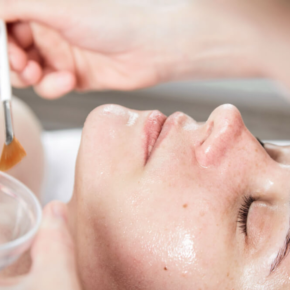 Chemical Peels