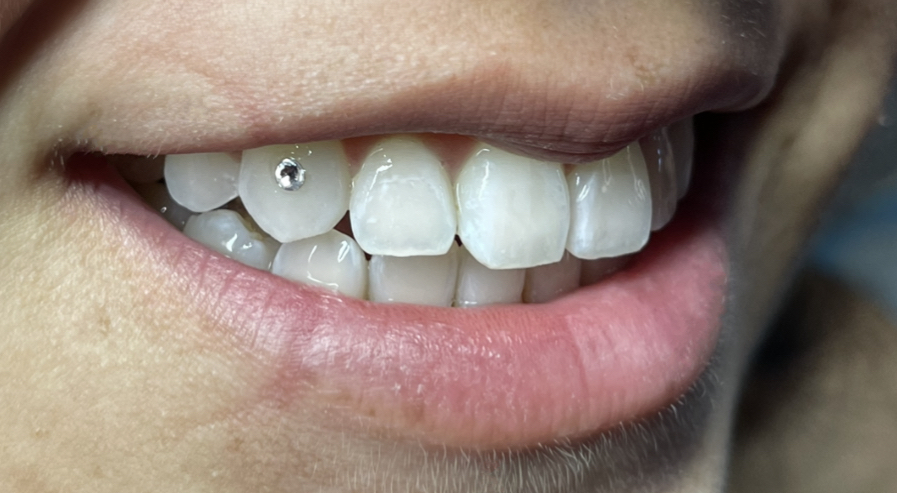 SINGLE TOOTHGEM