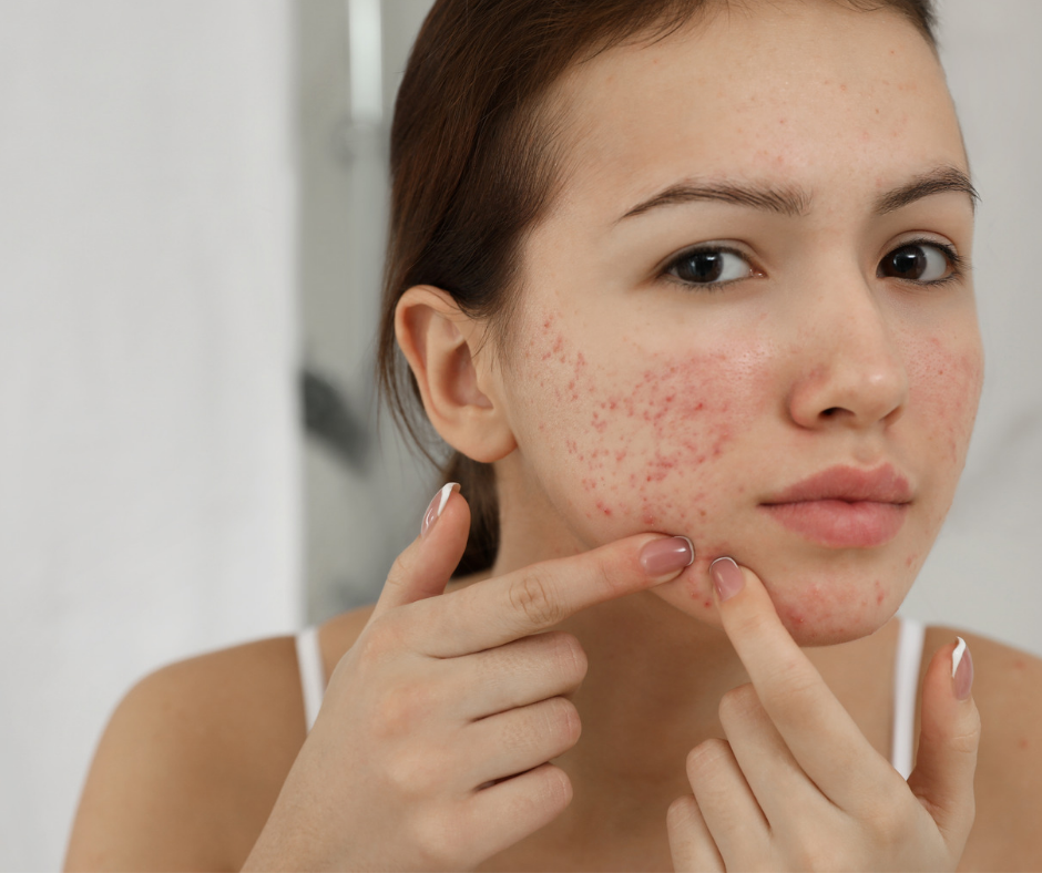 Teen Acne Treatment