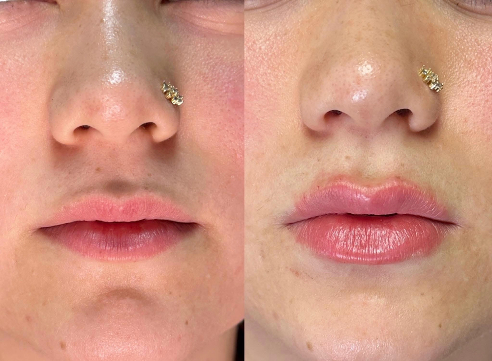 Lip Filler – Half Syringe (0.5 mL) at Safe Haven MedSpa in McAllen, TX