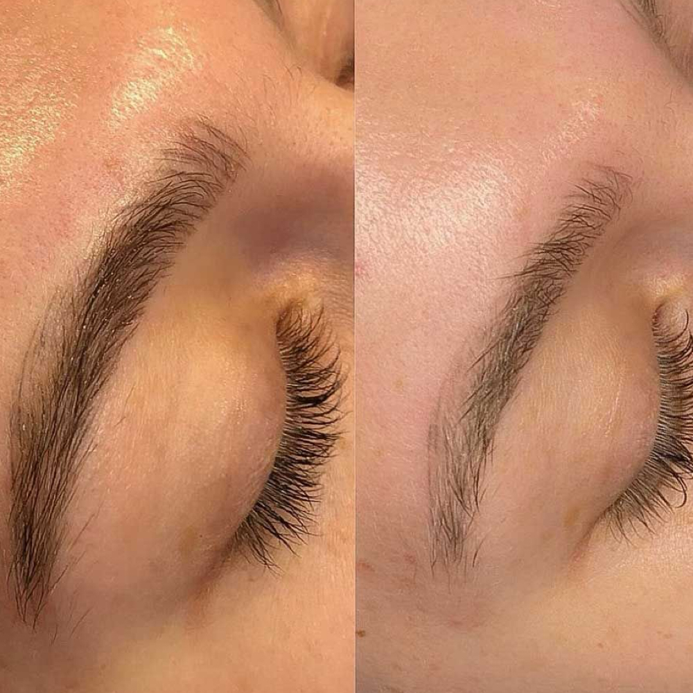 Saline Tattoo Removal at REAL MOXIE AESTHETICS in Las Vegas, NV