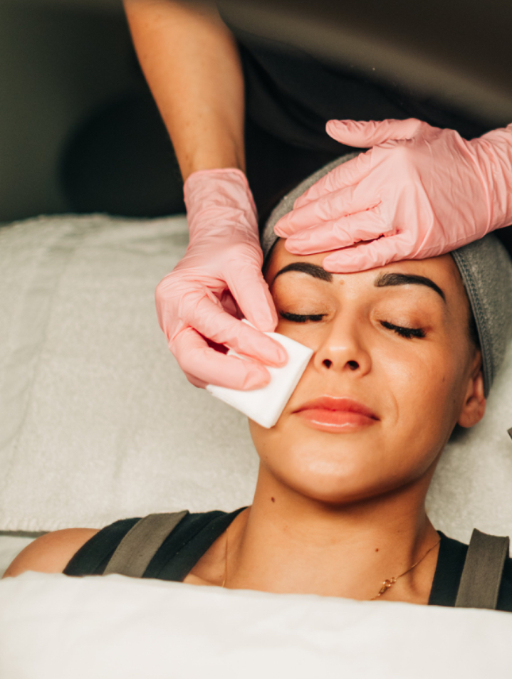 Chemical Peel